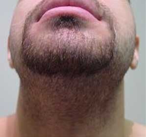 До фотоэпиляции