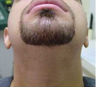 После фотоэпиляции