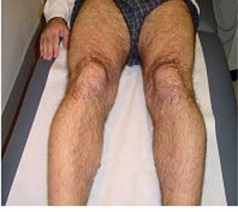 До фотоэпиляции