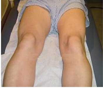 После фотоэпиляции