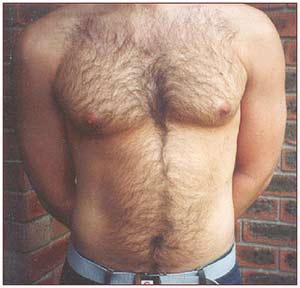 До фотоэпиляции