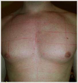 После фотоэпиляции