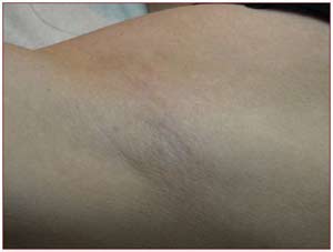 После фотоэпиляции