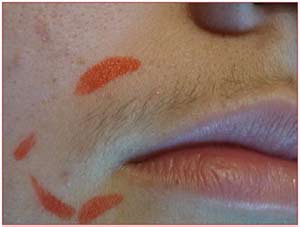 До фотоэпиляции