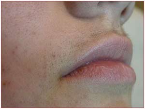 После фотоэпиляции